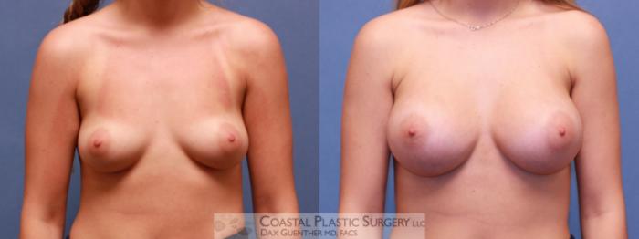 Before & After Breast Augmentation Case 72 Front View in Hingham, MA