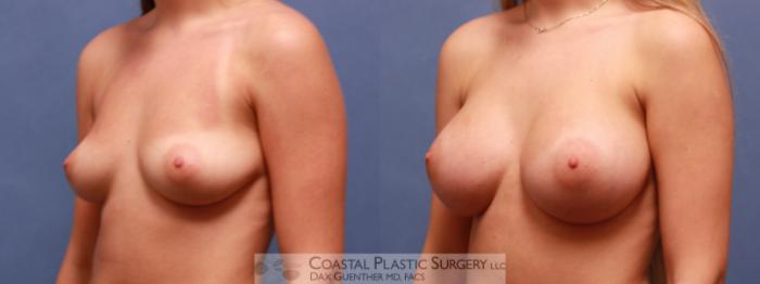 Before & After Breast Augmentation Case 72 Left Oblique View in Hingham, MA
