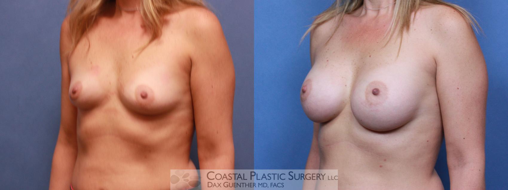 Before & After Breast Augmentation Case 75 View #1 View in Hingham, Boston & Nantucket, MA