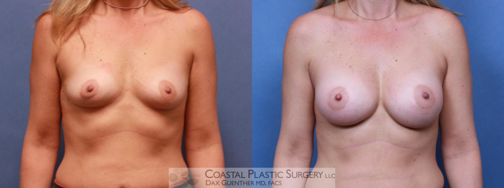 Before & After Breast Augmentation Case 75 View #2 View in Hingham, Boston & Nantucket, MA
