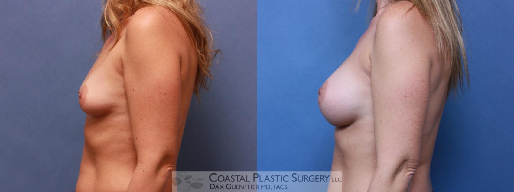 Before & After Breast Augmentation Case 75 View #3 View in Hingham, Boston & Nantucket, MA