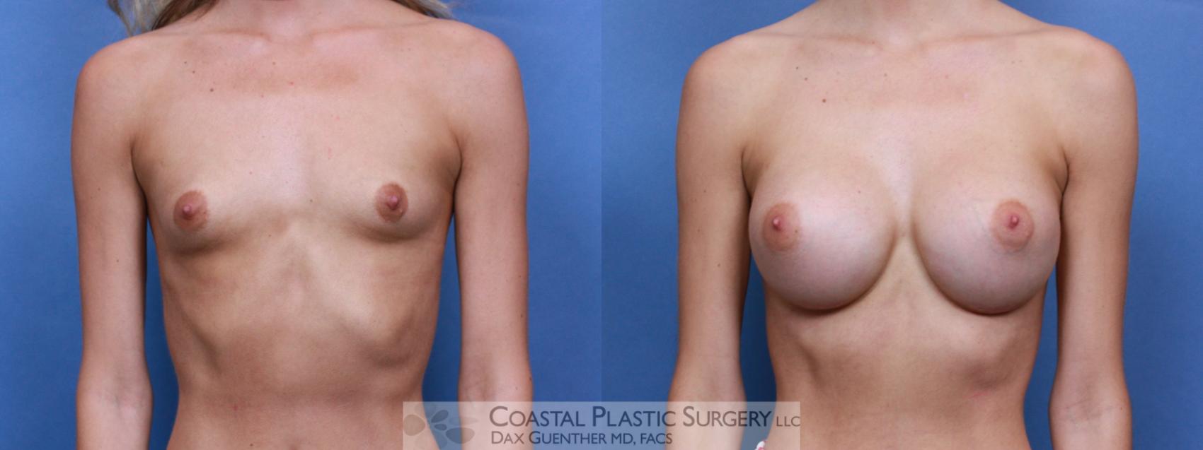 Before & After Breast Augmentation Case 89 Front View in Boston, MA