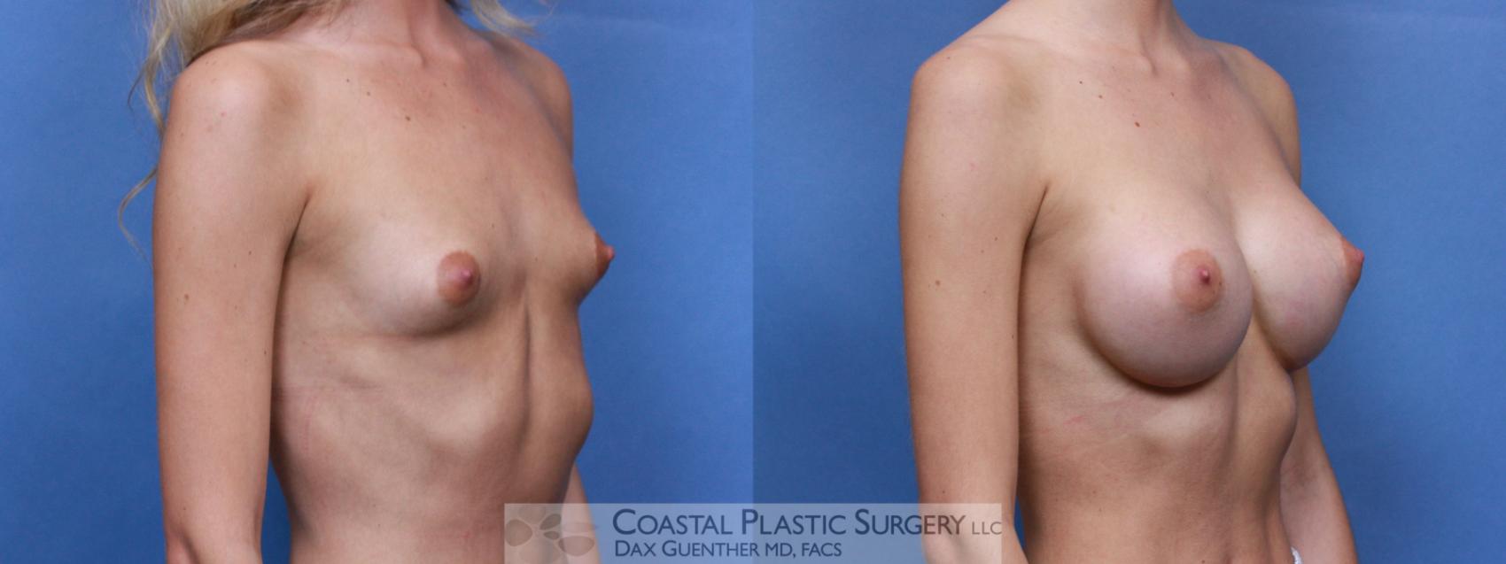 Before & After Breast Augmentation Case 89 Right Oblique View in Hingham, Boston & Nantucket, MA