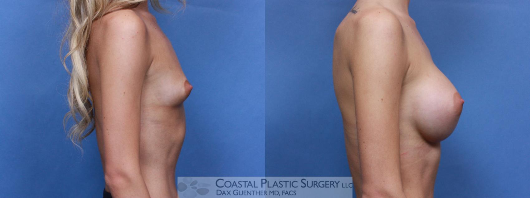 Before & After Breast Augmentation Case 89 Right Side View in Hingham, Boston & Nantucket, MA