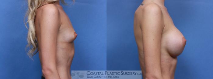 Before & After Breast Augmentation Case 89 Right Side View in Hingham, MA
