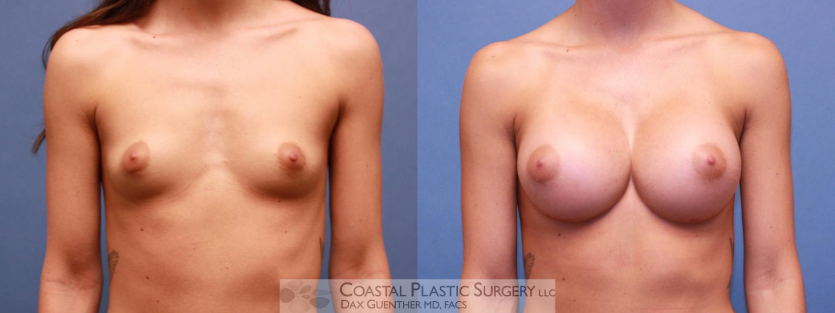 Before & After Breast Augmentation Case 98 Front View in Boston, MA
