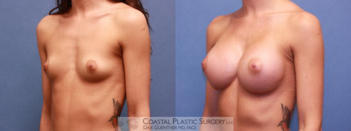 Before & After Breast Augmentation Case 98 Left Oblique View in Hingham, MA