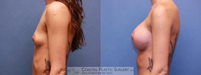 Before & After Breast Augmentation Case 98 Left Side View in Boston, MA