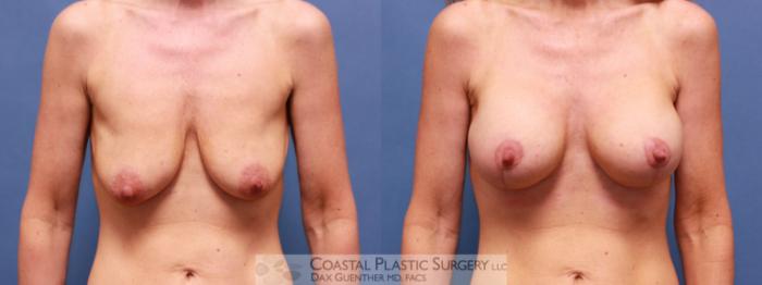 Before & After Breast Augmentation & Lift Case 16 View #1 View in Hingham, MA