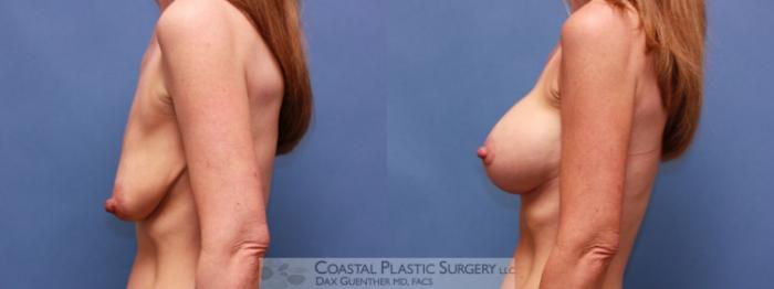 Before & After Breast Augmentation & Lift Case 16 View #2 View in Boston, MA