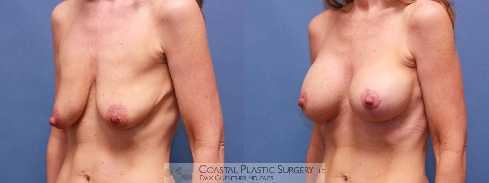 Before & After Breast Augmentation & Lift Case 16 View #3 View in Boston, MA