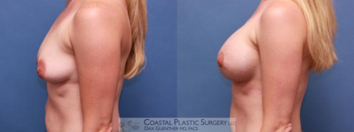 Before & After Breast Augmentation & Lift Case 18 View #3 View in Boston, MA