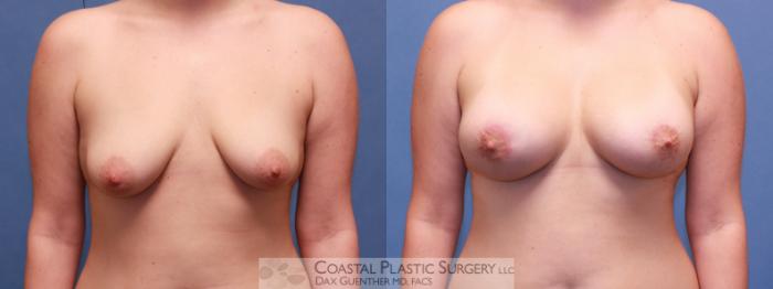 Before & After Breast Augmentation & Lift Case 45 View #1 View in Hingham, MA
