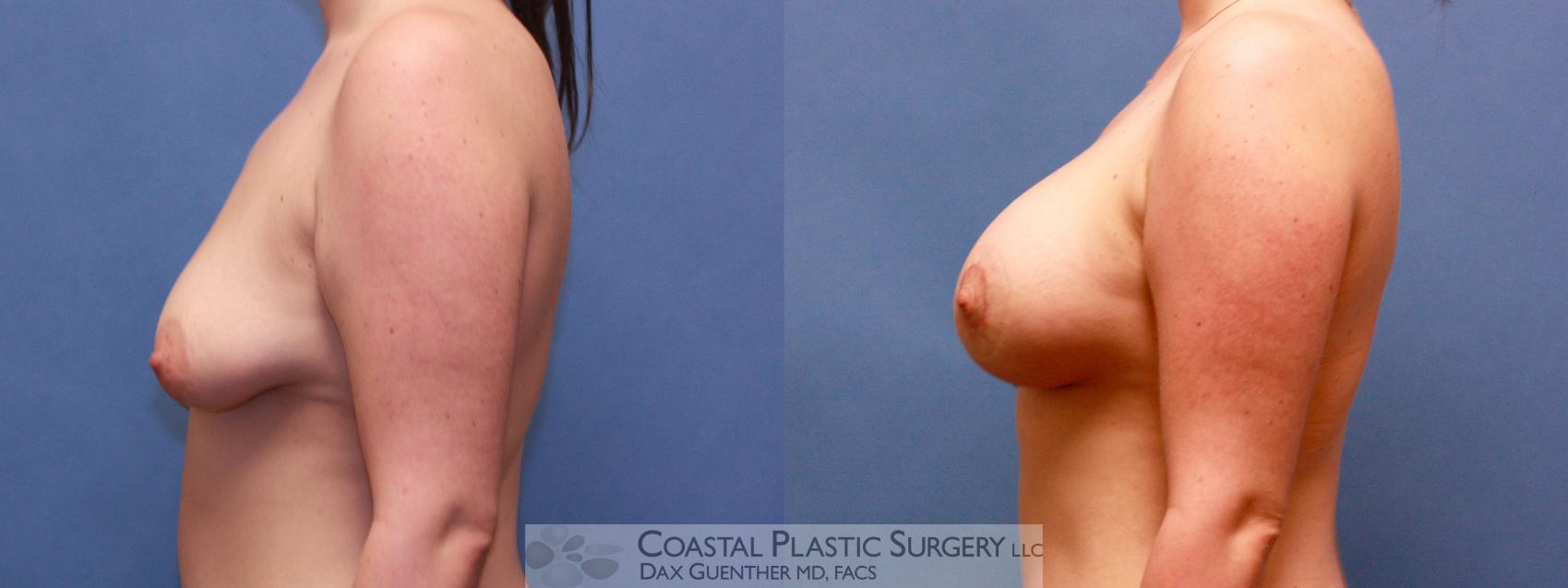 Before & After Breast Augmentation & Lift Case 45 View #2 View in Boston, MA