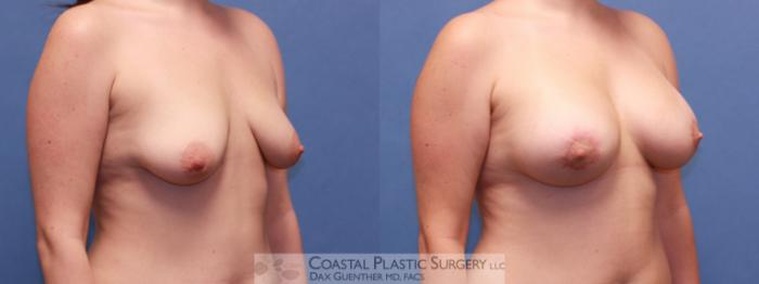 Before & After Breast Augmentation & Lift Case 45 View #3 View in Boston, MA