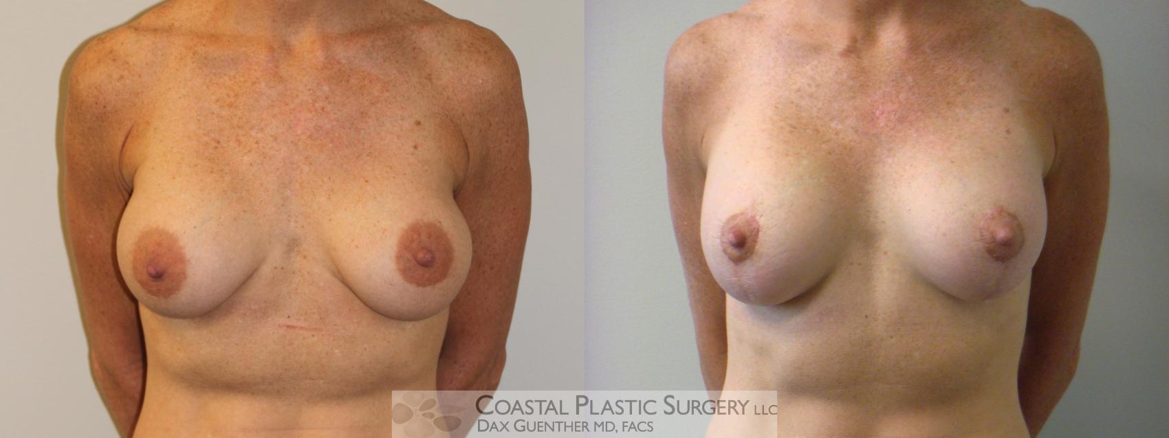 Before & After Breast Augmentation & Lift Case 5 View #1 View in Hingham, MA