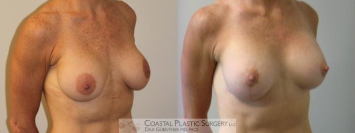 Before & After Breast Augmentation & Lift Case 5 View #2 View in Boston, MA