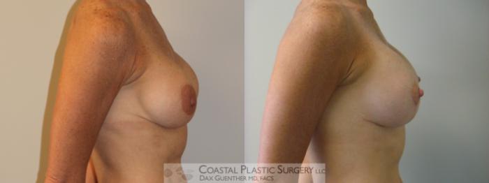 Before & After Breast Augmentation & Lift Case 5 View #3 View in Boston, MA