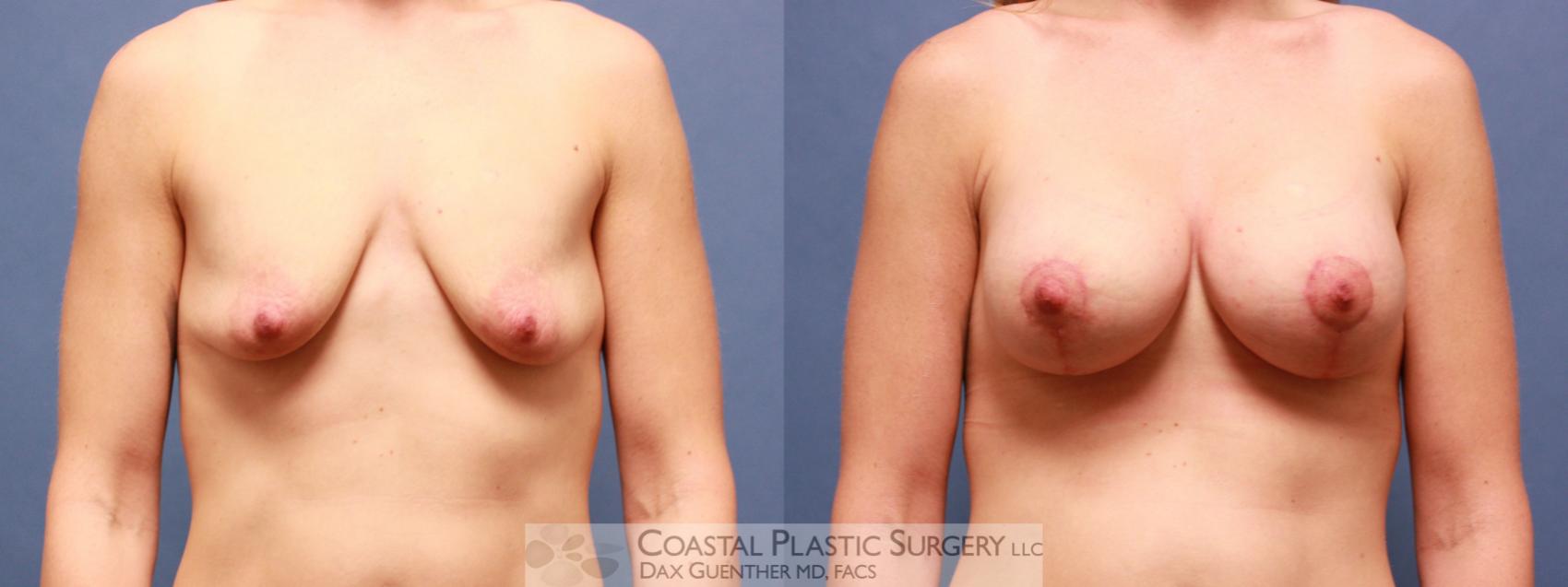 Before & After Breast Augmentation & Lift Case 51 View #1 View in Hingham, MA