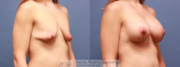 Before & After Breast Augmentation & Lift Case 51 View #3 View in Boston, MA