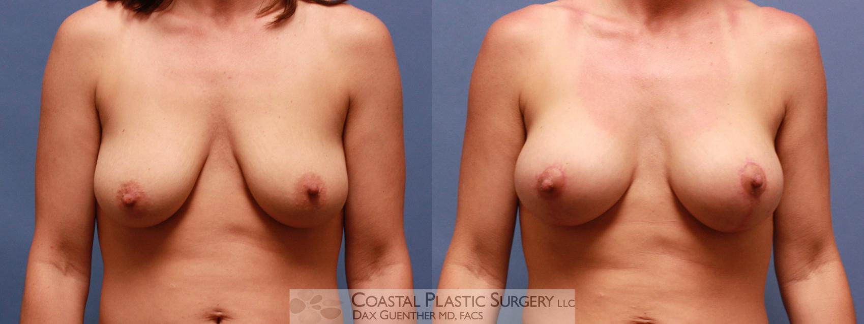 Before & After Breast Augmentation & Lift Case 61 View #1 View in Hingham, MA