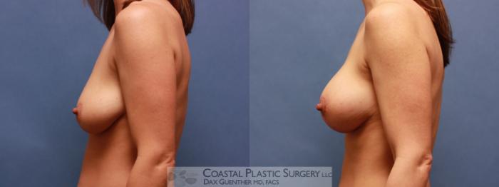 Before & After Breast Augmentation & Lift Case 61 View #2 View in Boston, MA