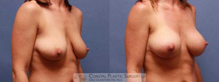 Before & After Breast Augmentation & Lift Case 61 View #3 View in Boston, MA