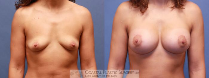 Before & After Breast Augmentation & Lift Case 76 View #1 View in Hingham, MA