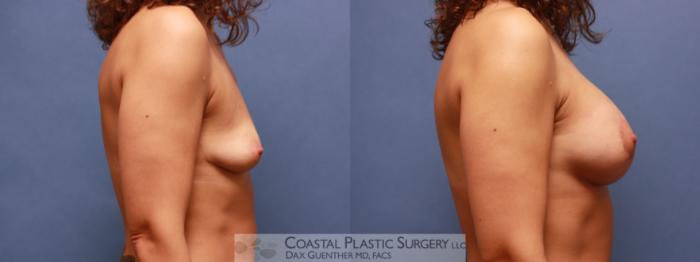 Before & After Breast Augmentation & Lift Case 76 View #3 View in Boston, MA