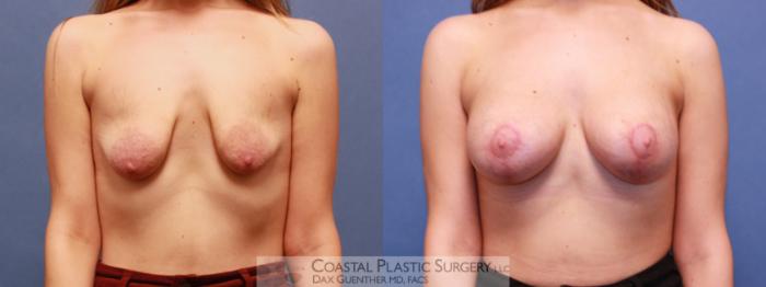 Before & After Breast Augmentation & Lift Case 83 View #1 View in Hingham, MA