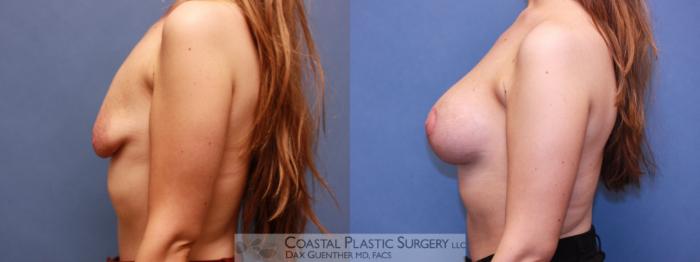 Before & After Breast Augmentation & Lift Case 83 View #2 View in Boston, MA