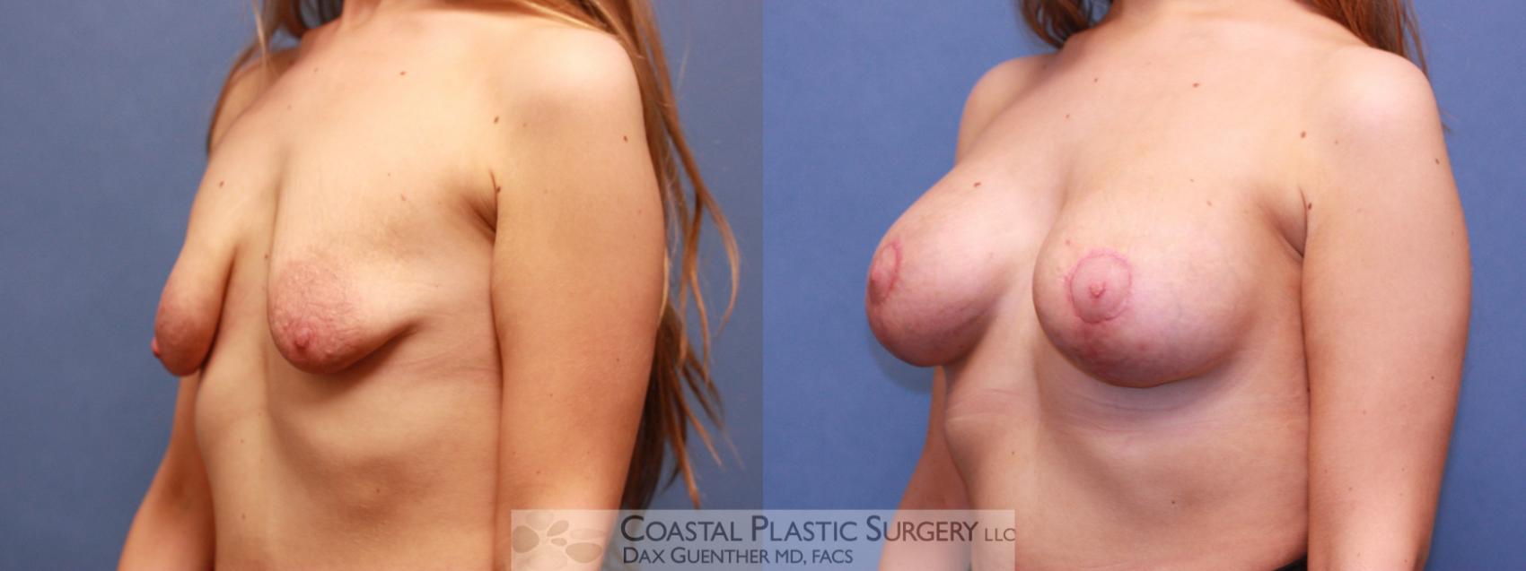 Before & After Breast Augmentation & Lift Case 83 View #3 View in Boston, MA