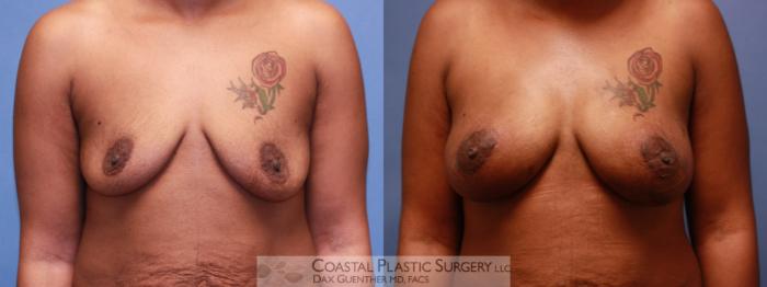 Before & After Breast Fat Transfer Case 63 View #1 View in Boston, MA