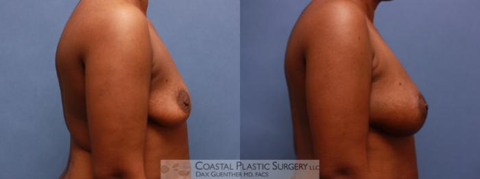 Before & After Breast Fat Transfer Case 63 View #2 View in Boston, MA