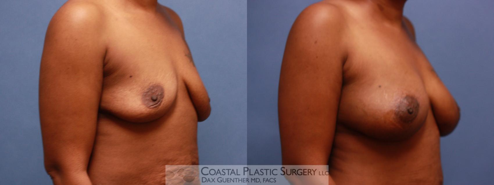 Before & After Breast Fat Transfer Case 63 View #3 View in Hingham, MA