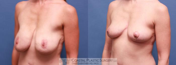 Before & After Breast Lift Case 15 View #2 View in Boston, MA