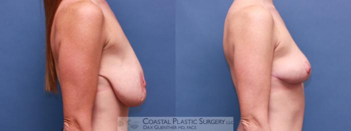 Before & After Breast Lift Case 15 View #3 View in Boston, MA