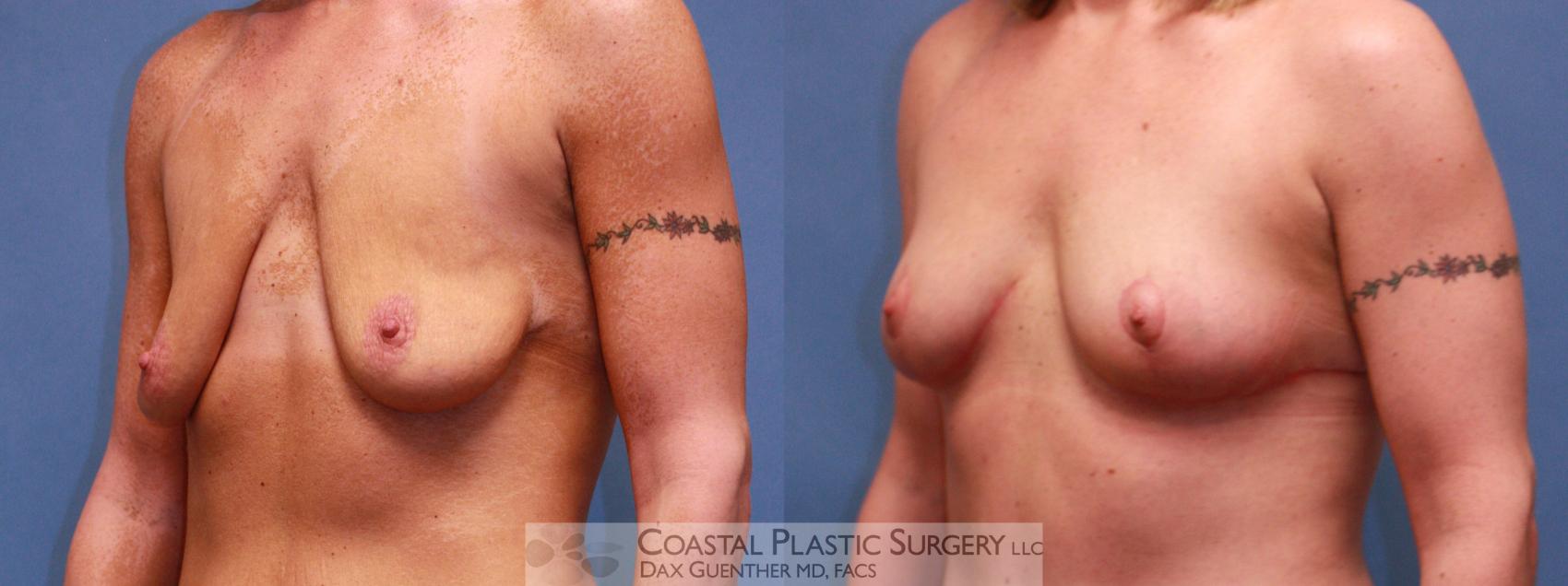 Before & After Breast Lift Case 38 View #2 View in Boston, MA