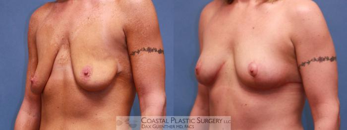 Before & After Breast Lift Case 38 View #2 View in Boston, MA