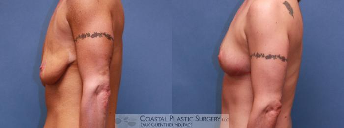 Before & After Breast Lift Case 38 View #3 View in Boston, MA