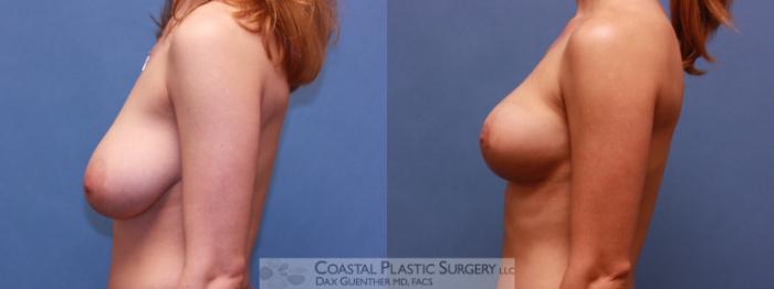 Before & After Breast Lift Case 42 View #2 View in Boston, MA