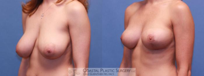 Before & After Breast Lift Case 42 View #3 View in Boston, MA