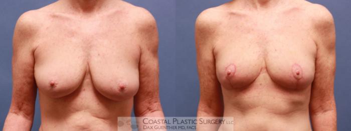 Before & After Breast Lift Case 59 View #1 View in Hingham, MA