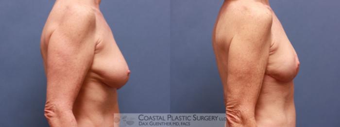 Before & After Breast Lift Case 59 View #3 View in Boston, MA