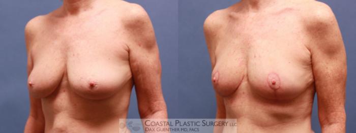 Before & After Breast Lift Case 59 View #4 View in Boston, MA