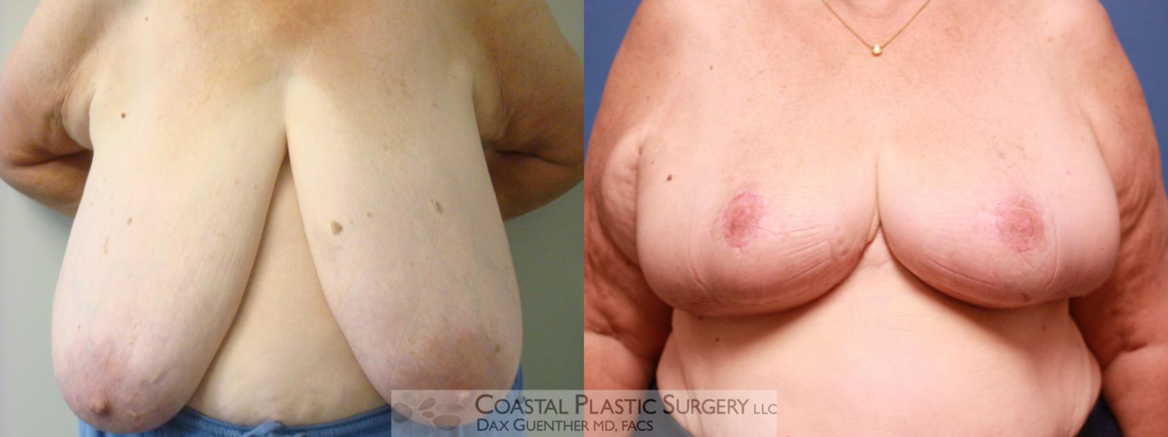 Before & After Breast Reduction Case 10 View #1 View in Hingham, Boston & Nantucket, MA