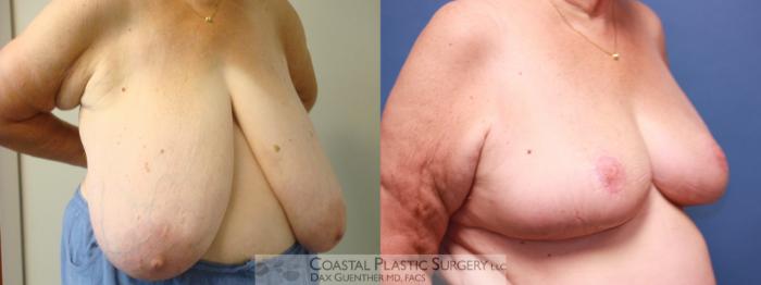 Before & After Breast Reduction Case 10 View #2 View in Boston, MA