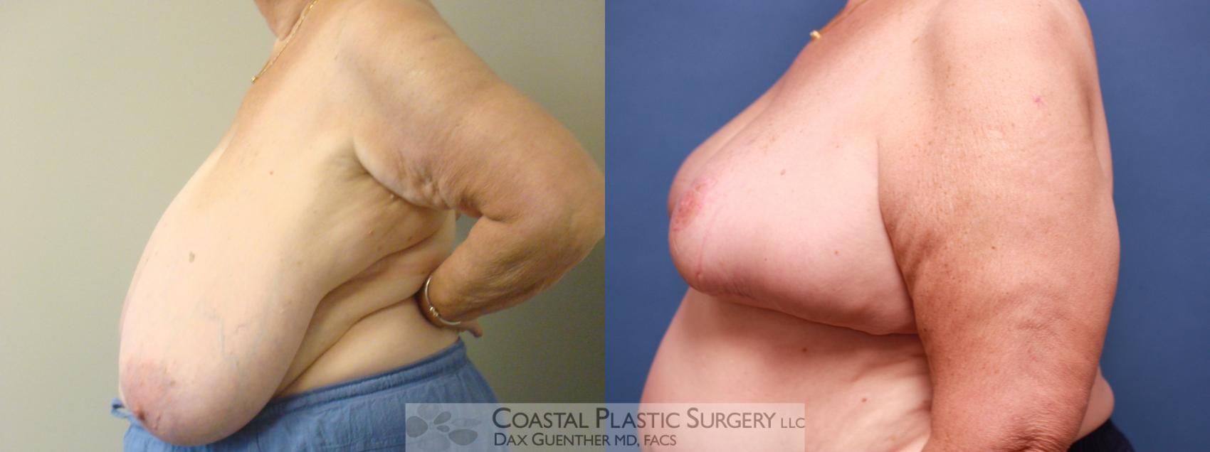 Before & After Breast Reduction Case 10 View #3 View in Boston, MA