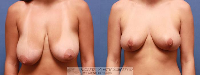 Before & After Breast Reduction Case 20 View #1 View in Boston, MA