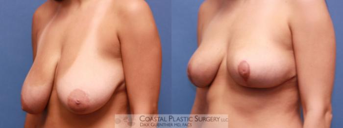 Before & After Breast Reduction Case 20 View #2 View in Boston, MA